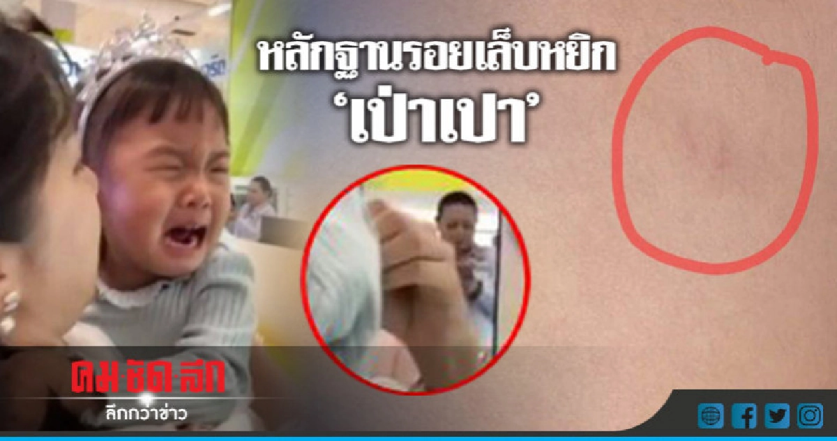 รอยเล็บชัดเจน!! 'เป่าเปา' เล่าเหตุการณ์ถูกหยิก รอยเล็บชัดเจน!! 'เป่าเปา' เล่าเหตุการณ์ถูกหยิก