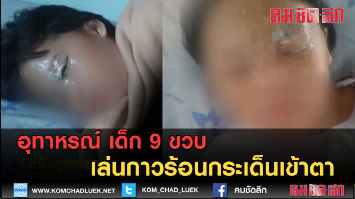 (คลิปข่าว) อุทาหรณ์ เด็ก 9 ขวบ เล่นกาวร้อนกระเด็นเข้าตา 