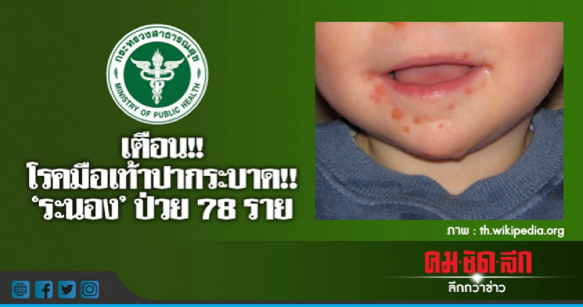 เตือน!! โรคมือเท้าปากระบาด!!  