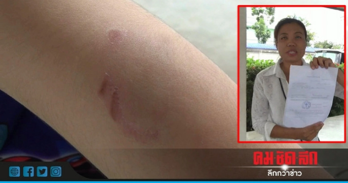 แม่โวย !! ลูกถูกเพื่อนกัดเป็นแผล 4 ครั้ง