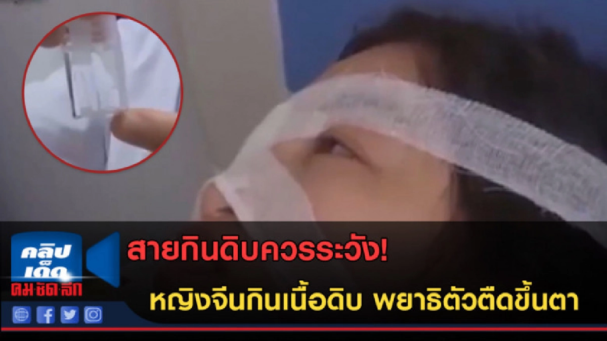 (คลิปข่าว)สายกินดิบควรระวัง! หญิงจีนกินเนื้่อดิบ พยาธิขึ้นตา (คลิปข่าว)สายกินดิบควรระวัง! หญิงจีนกินเนื้่อดิบ พยาธิขึ้นตา