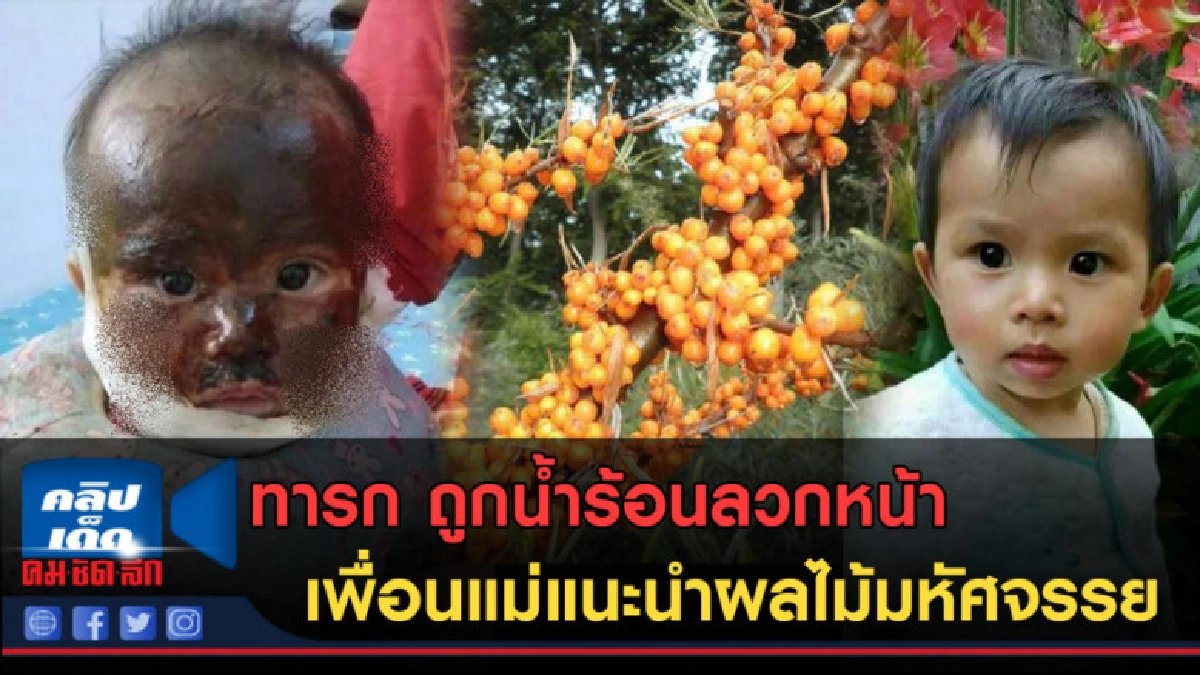 (คลิปข่าว) ทารก1ขวบถูกน้ำร้อนลวกหน้าเพื่อนแม่แนะนำผลไม้รักษา (คลิปข่าว) ทารก1ขวบถูกน้ำร้อนลวกหน้าเพื่อนแม่แนะนำผลไม้รักษา