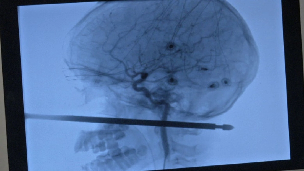 หนึ่งในล้าน! 10ขวบรอดเหล็กเสียบเนื้อแทงหน้าทะลุกะโหลก