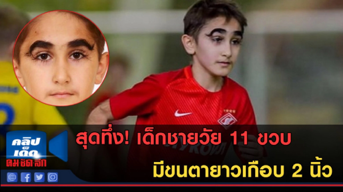 (คลิปข่าว) เด็กชายวัย 11 ขวบ มีขนตายาวเกือบ 2 นิ้ว (คลิปข่าว) เด็กชายวัย 11 ขวบ มีขนตายาวเกือบ 2 นิ้ว