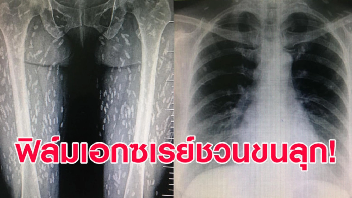 ชวนขนลุก! เผยภาพฟิล์มเอกซเรย์ผู้ป่วยที่ชอบกินเนื้อแบบไม่สุก ชวนขนลุก! เผยภาพฟิล์มเอกซเรย์ผู้ป่วยที่ชอบกินเนื้อแบบไม่สุก