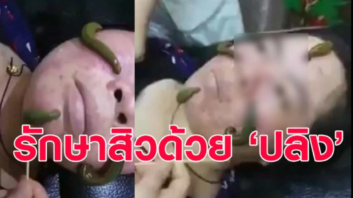ชวนขนลุก! วิธีการรักษาสิว ด้วยการเอาปลิงมาดูดที่ใบหน้า ชวนขนลุก! วิธีการรักษาสิว ด้วยการเอาปลิงมาดูดที่ใบหน้า