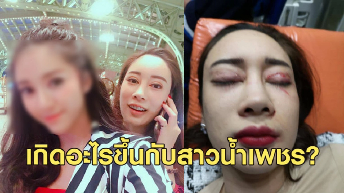 น้ำเพชรโชว์สภาพหน้าเยิน ของดตอบสื่อเรื่องเพื่อนคู่กรณี น้ำเพชรโชว์สภาพหน้าเยิน ของดตอบสื่อเรื่องเพื่อนคู่กรณี