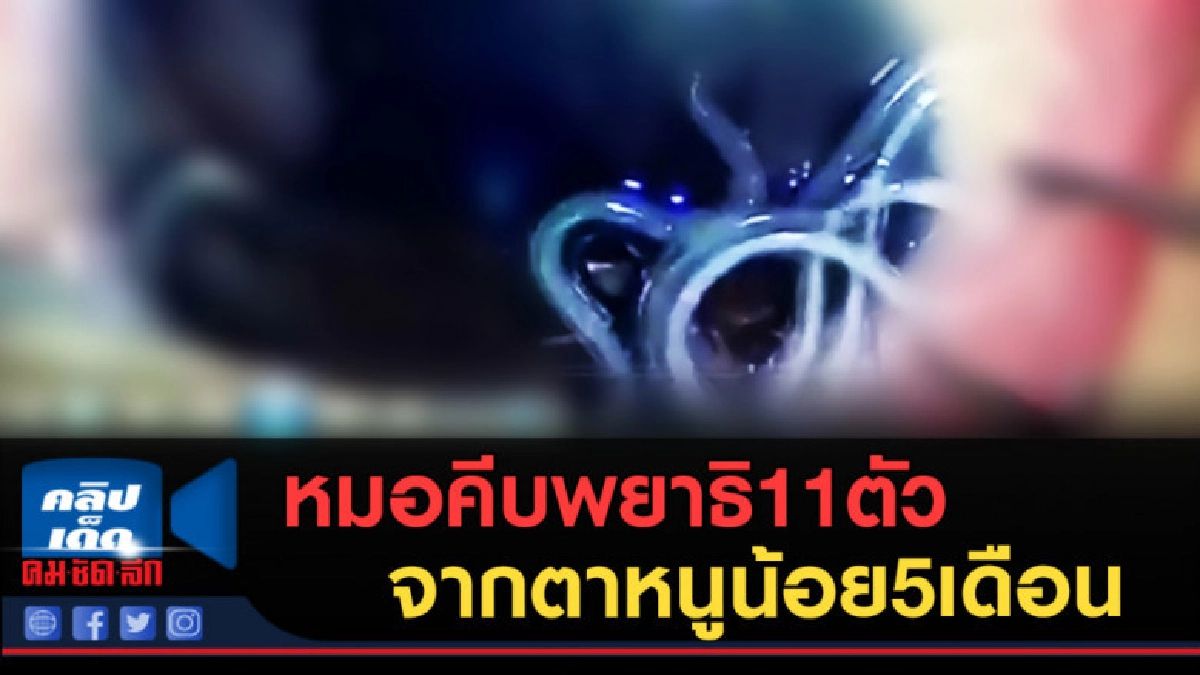 (คลิปข่าว) ระทึก! หมอคีบพยาธิ11ตัว จากตาหนูน้อย5เดือน (คลิปข่าว) ระทึก! หมอคีบพยาธิ11ตัว จากตาหนูน้อย5เดือน