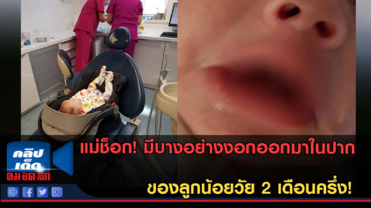(คลิปข่าว)แม่สุดช็อก หลังพบบางสิ่งงอกออกจากปากลูกวัย2เดือน (คลิปข่าว)แม่สุดช็อก หลังพบบางสิ่งงอกออกจากปากลูกวัย2เดือน
