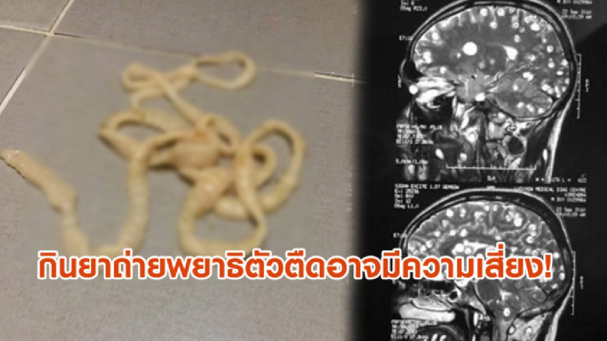 เพจจ่าโพสต์เตือน กินยาถ่ายพยาธิตัวตืดผิดวิธี อาจมีความเสี่ยง เพจจ่าโพสต์เตือน กินยาถ่ายพยาธิตัวตืดผิดวิธี อาจมีความเสี่ยง