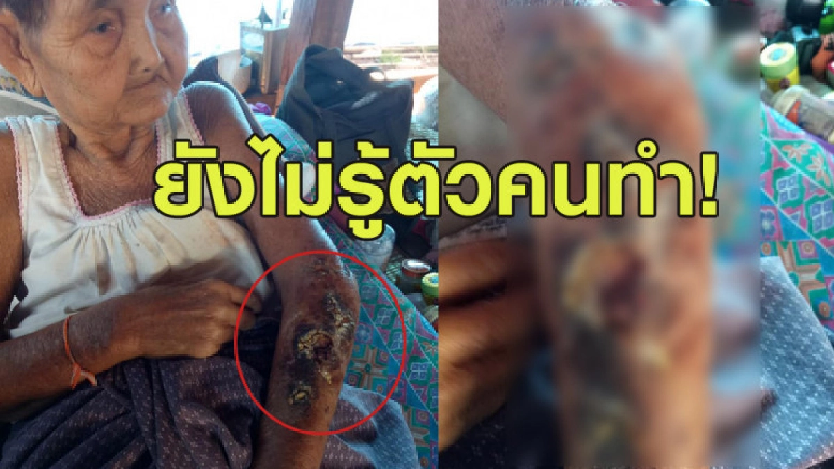 สาวโพสต์ระบาย ย่าถูกพยาบาลมือหนักกระชากแขนจนแผลเหวอะติดเชื้อ