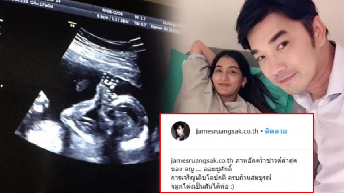 ได้ลูกสาว! เจมส์ เรืองศักดิ์ เผยภาพอัลตราซาวด์ รับเห่อสุดๆ ได้ลูกสาว! เจมส์ เรืองศักดิ์ เผยภาพอัลตราซาวด์ รับเห่อสุดๆ