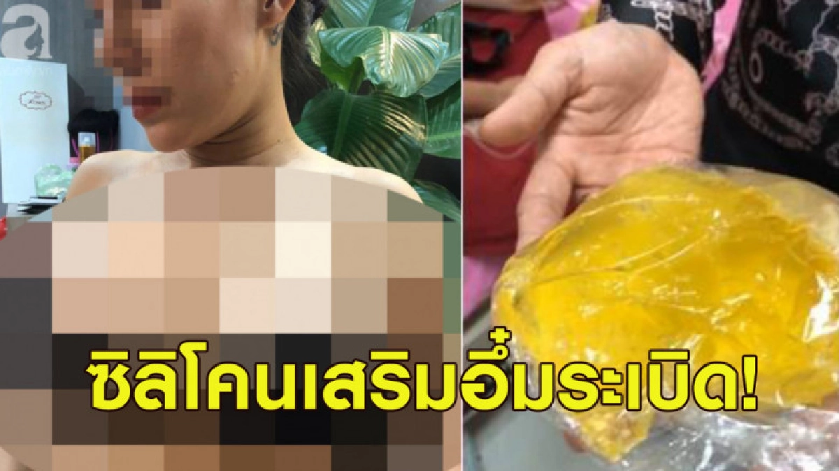สาวอกระเบิดระหว่างขึ้นเครื่อง เล่า ปสก.เลือกซิลิโคนเกรดต่ำ สาวอกระเบิดระหว่างขึ้นเครื่อง เล่า ปสก.เลือกซิลิโคนเกรดต่ำ