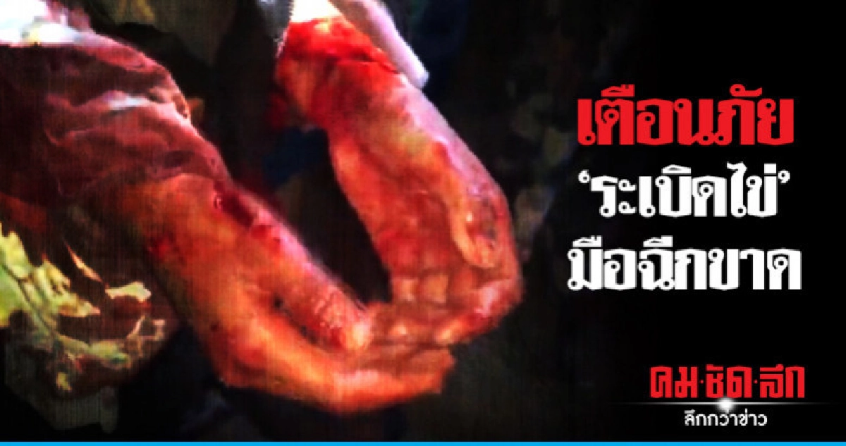 เตือนภัยเด็กเล่นระเบิดไข่มือฉีกขาด