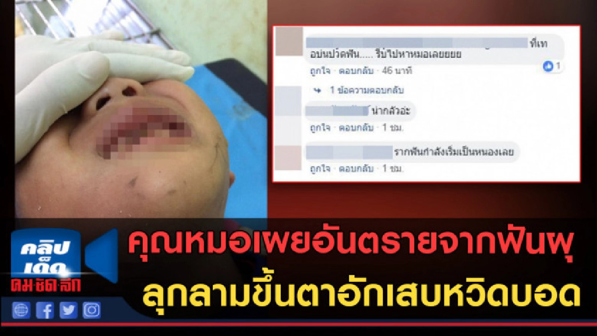 (คลิปข่าว) อย่าละเลย!! คุณหมอเผยอันตรายจากฟันผุ (คลิปข่าว) อย่าละเลย!! คุณหมอเผยอันตรายจากฟันผุ