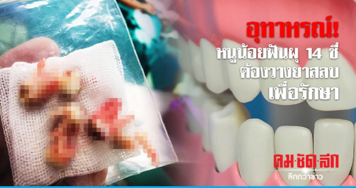 อุทาหรณ์! หนูน้อยฟันผุ 14 ซี่ ต้องวางยาสลบเพื่อรักษา อุทาหรณ์! หนูน้อยฟันผุ 14 ซี่ ต้องวางยาสลบเพื่อรักษา