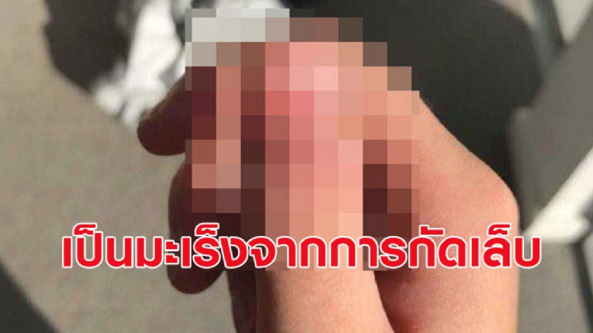 นิสัยชอบกัดเล็บ สุ่มเสี่ยงเป็นมะเร็งผิวหนัง นิสัยชอบกัดเล็บ สุ่มเสี่ยงเป็นมะเร็งผิวหนัง