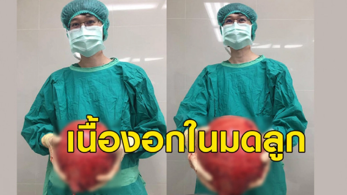 หมอโพสต์เตือนเคสผ่าตัดเนื้องอกในมดลูก พบขนาดใหญ่เท่าลูกบาส
