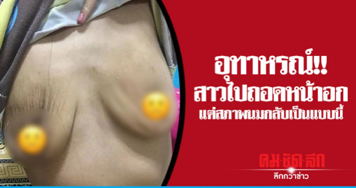 อุทาหรณ์!! สาวไปถอดหน้าอก แต่สภาพนมกลับเป็นแบบนี้ อุทาหรณ์!! สาวไปถอดหน้าอก แต่สภาพนมกลับเป็นแบบนี้