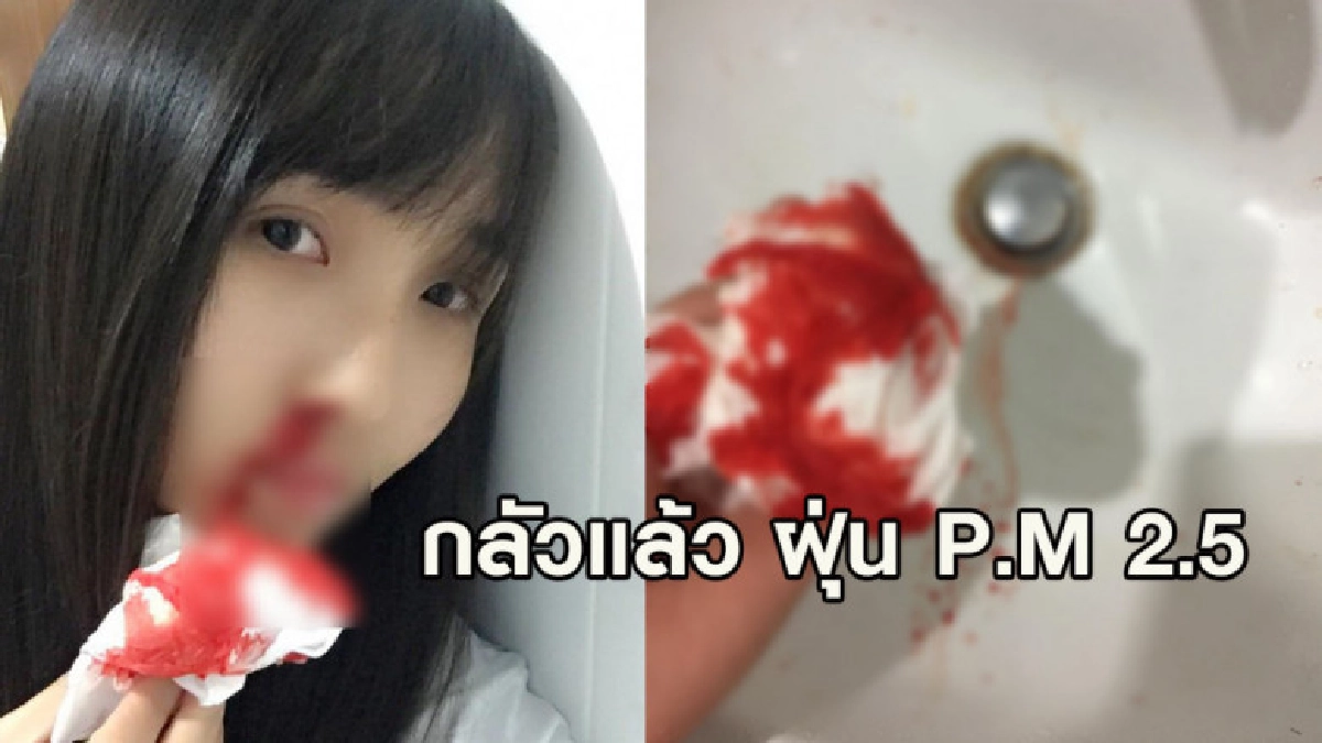 สาวโพสต์เตือน! ลืมใส่หน้ากากอนามัย พอจามออกมาเลือดไหลเป็นทาง