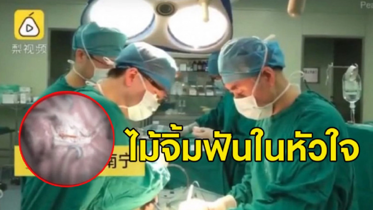 หมอตะลึง ผ่าตัดหัวใจหนุ่มจีน เจอไม้จิ้มฟันยาว 6 ซม.ติดอยู่ หมอตะลึง ผ่าตัดหัวใจหนุ่มจีน เจอไม้จิ้มฟันยาว 6 ซม.ติดอยู่