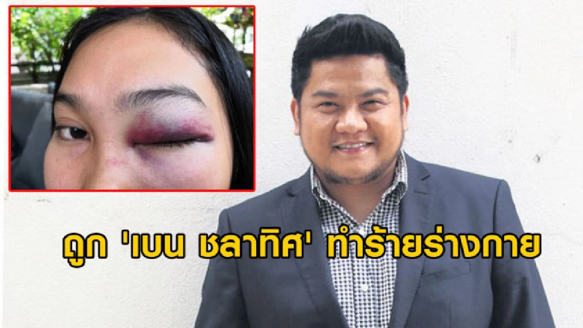 สาวร้องถูก 'เบน ชลาทิศ' ตบแก้ม-ชกตาซ้ายเขียวช้ำ สาวร้องถูก 'เบน ชลาทิศ' ตบแก้ม-ชกตาซ้ายเขียวช้ำ