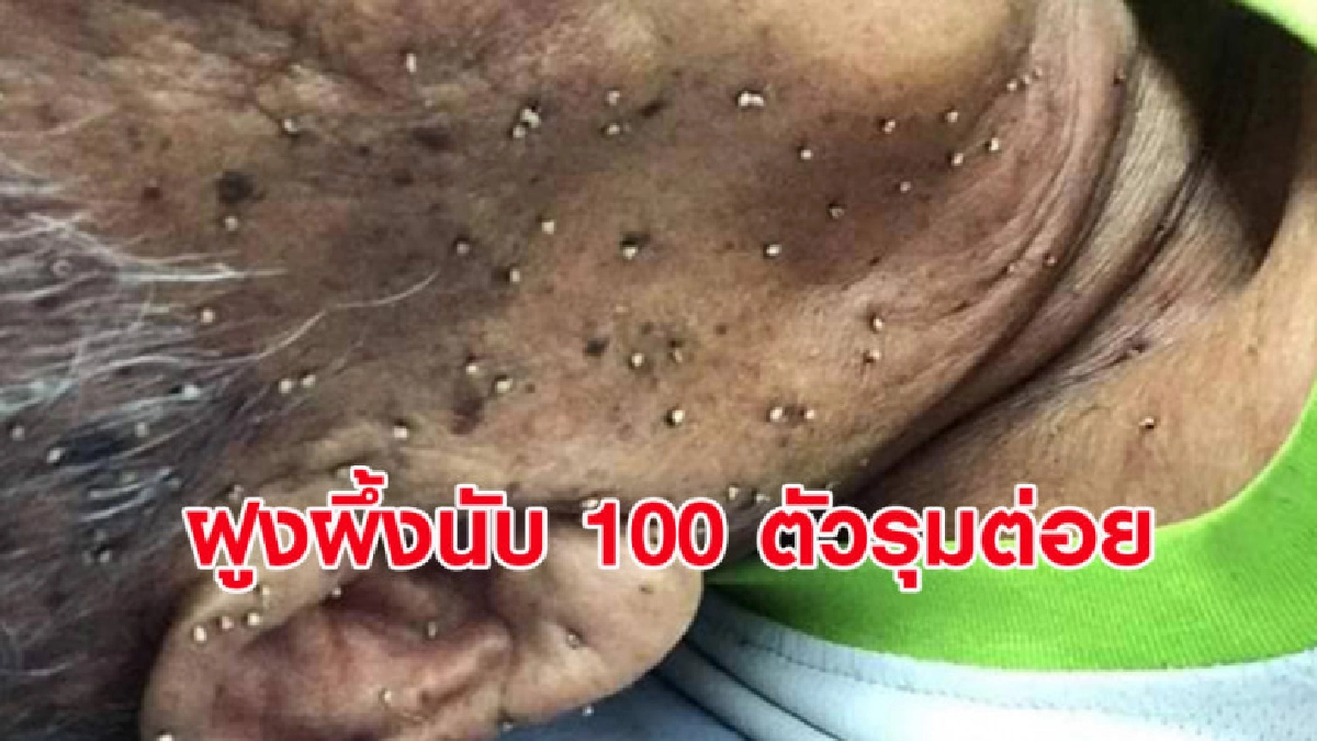 ขนลุกซู่! คุณตาวัย 85 ถูกฝูงผึ้งนับร้อยตัวรุมต่อยอาการสาหัส ขนลุกซู่! คุณตาวัย 85 ถูกฝูงผึ้งนับร้อยตัวรุมต่อยอาการสาหัส