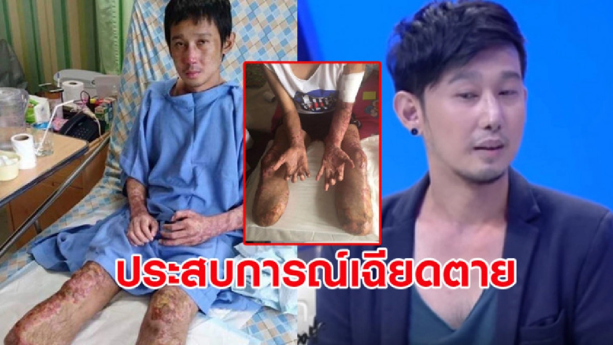 อุทาหรณ์ หนุ่มกินหลู้หมูดิบติดเชื้อในกระแสเลือดต้องตัดขาทิ้ง อุทาหรณ์ หนุ่มกินหลู้หมูดิบติดเชื้อในกระแสเลือดต้องตัดขาทิ้ง