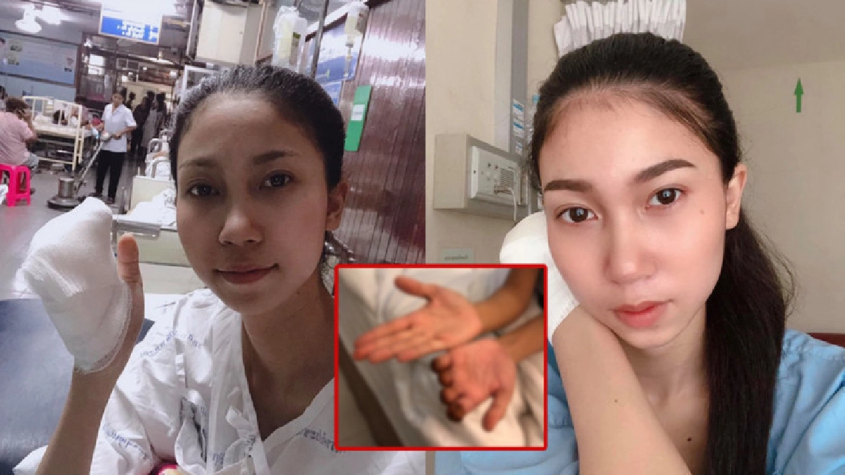 บัณฑิตสาวโพสต์เตือนใจครบ 1 เดือนที่ตนถูกตัดนิ้วระหว่างฝึกงาน