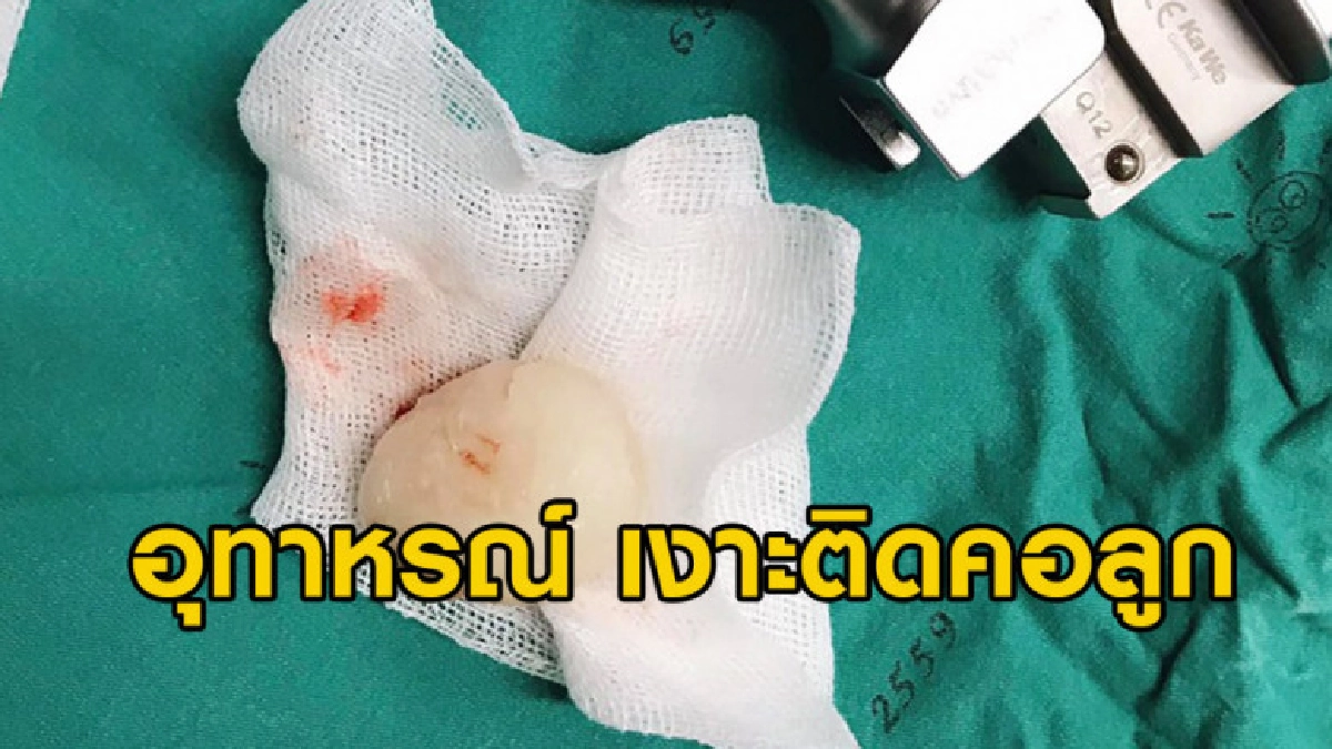 หมอเตือนพ่อแม่ หลังเกิดกรณีเงาะติดคอลูก-หัวใจหยุดเต้น หมอเตือนพ่อแม่ หลังเกิดกรณีเงาะติดคอลูก-หัวใจหยุดเต้น