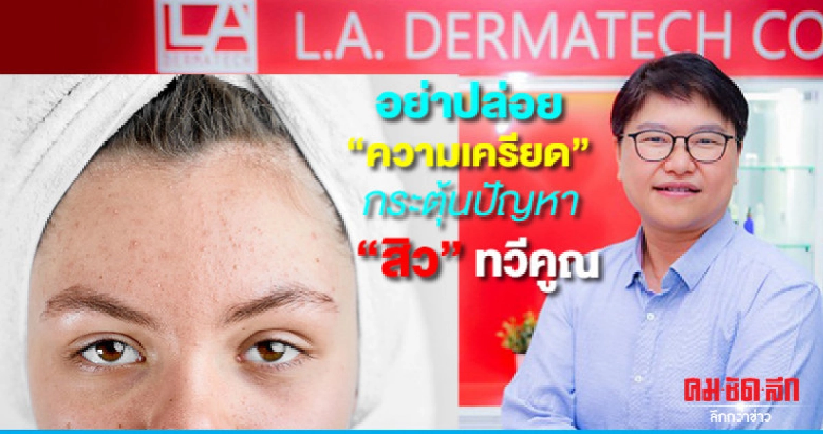 อย่าปล่อย "ความเครียด" กระตุ้น "สิว" ทวีคูณ อย่าปล่อย "ความเครียด" กระตุ้น "สิว" ทวีคูณ