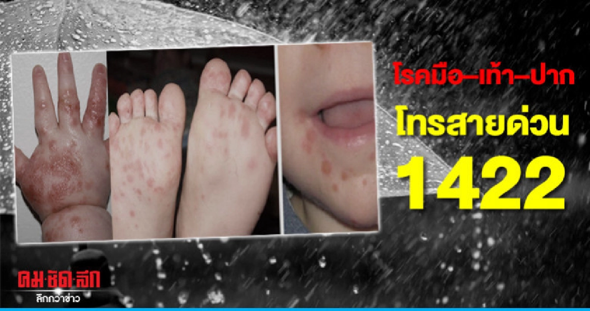 โรคมือ–เท้า–ปากโทรสายด่วน 1422 โรคมือ–เท้า–ปากโทรสายด่วน 1422
