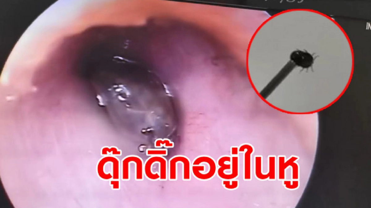 หมอใช้กล้องส่องหูคนไข้ ผงะเจอเห็บตัวใหญ่ไต่ดุ๊กดิ๊ก