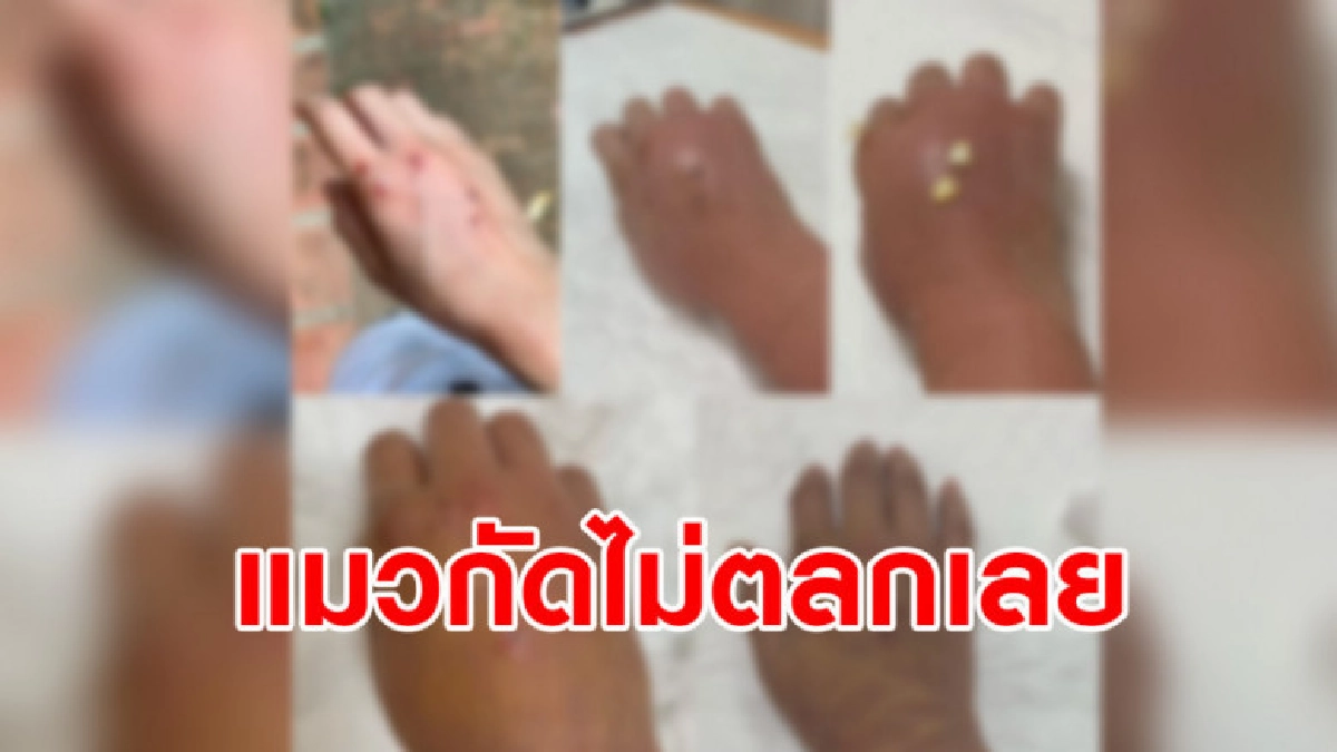 ทาสแมวโปรดทราบ ถูกแมวกัดอย่าคิดว่าเป็นเรื่องขำๆ ทาสแมวโปรดทราบ ถูกแมวกัดอย่าคิดว่าเป็นเรื่องขำๆ