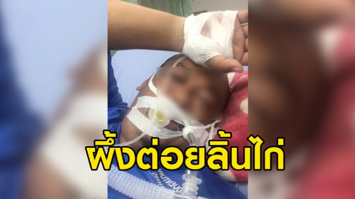 หนุ่มเล่าดูดน้ำไม่เห็นผึ้งอยู่ในหลอดถูกต่อยลิ้นไก่หวิดดับ หนุ่มเล่าดูดน้ำไม่เห็นผึ้งอยู่ในหลอดถูกต่อยลิ้นไก่หวิดดับ
