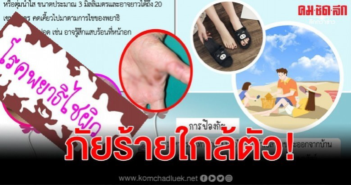 เตือน เดินเท้าเปล่า-นั่งสัมผัสดิน เสี่ยงพยาธิไชทะลุผิวหนัง เตือน เดินเท้าเปล่า-นั่งสัมผัสดิน เสี่ยงพยาธิไชทะลุผิวหนัง