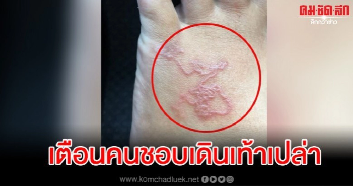 เตือนคนชอบเดินเท้าเปล่า ระวังพยาธิไชเท้าเห็นภาพชวนขนลุกสุดๆ เตือนคนชอบเดินเท้าเปล่า ระวังพยาธิไชเท้าเห็นภาพชวนขนลุกสุดๆ