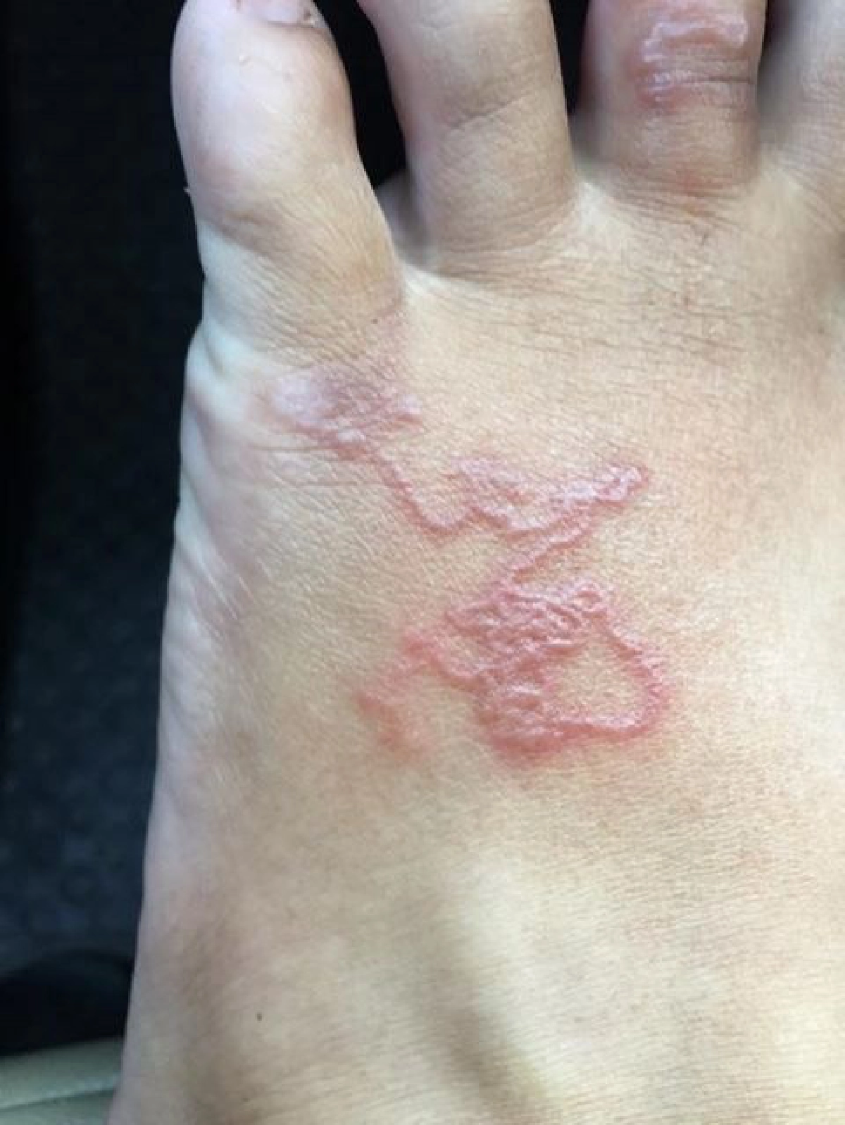 เตือนคนชอบเดินเท้าเปล่า ระวังพยาธิไชเท้าเห็นภาพชวนขนลุกสุดๆ