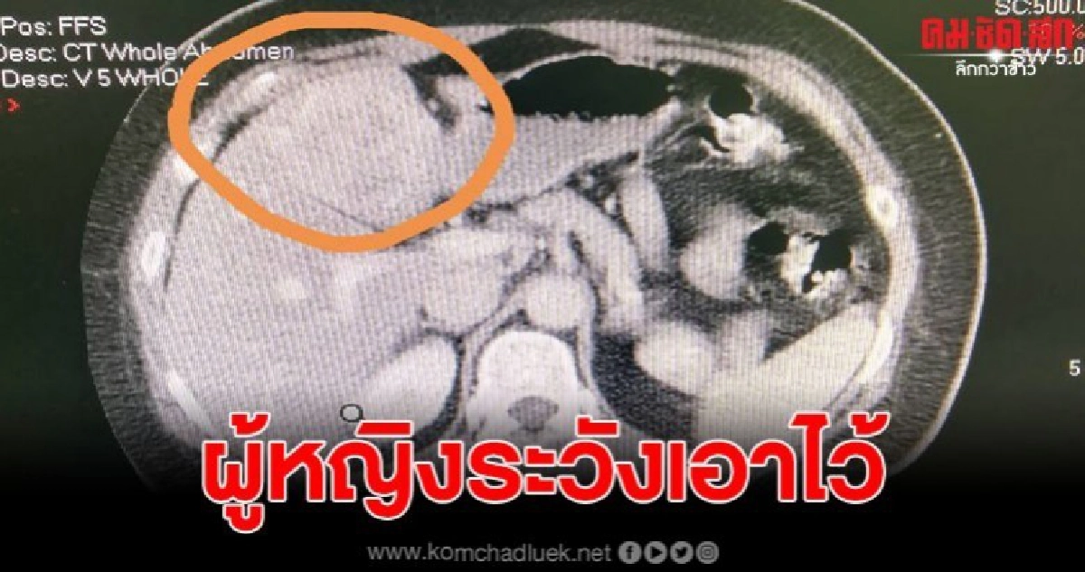 สาววัย 38 ใช้ยาคุมกำเนิดนาน 10 ปี ก่อนร่างกายผิดปกติ สาววัย 38 ใช้ยาคุมกำเนิดนาน 10 ปี ก่อนร่างกายผิดปกติ