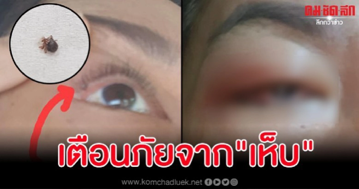 เรื่องใกล้ตัว สาวเข้าพักที่เกาะช้างเจอเห็บเกาะใต้ตากัดบวมปูด เรื่องใกล้ตัว สาวเข้าพักที่เกาะช้างเจอเห็บเกาะใต้ตากัดบวมปูด