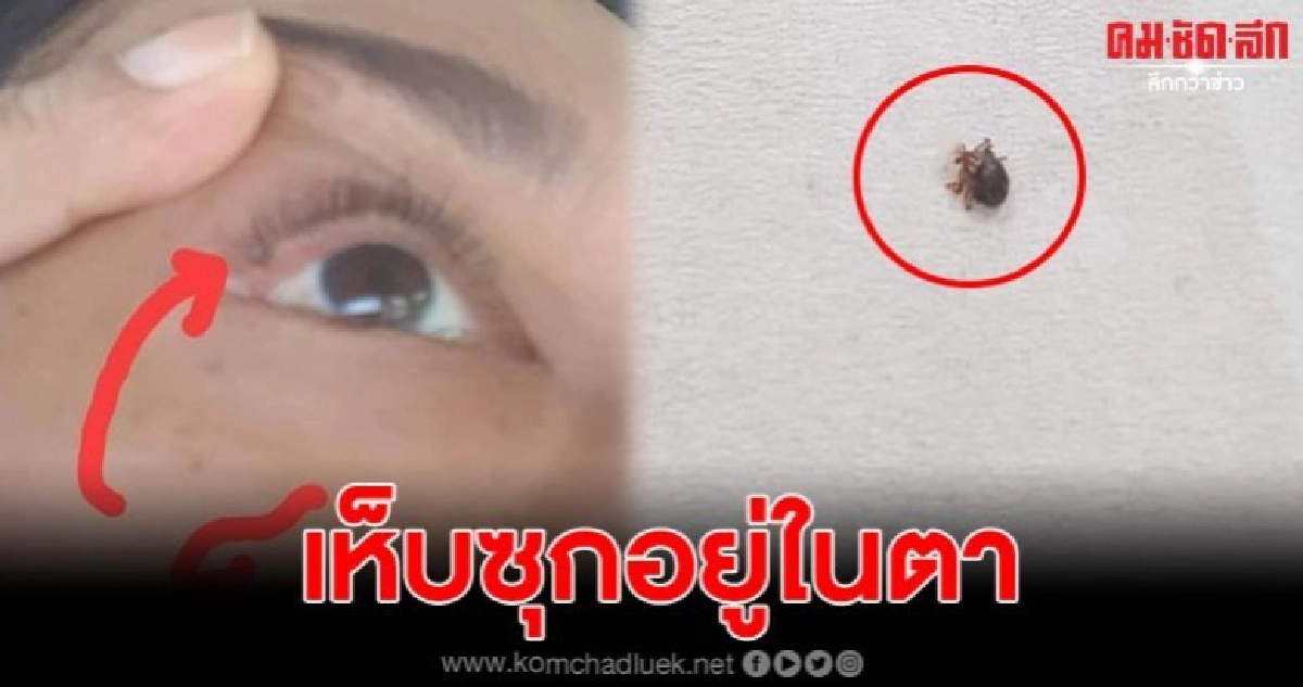 สาวเจอเห็บสุนัข ซุกอยู่ใต้ตา จนตาบวมเป่ง สาวเจอเห็บสุนัข ซุกอยู่ใต้ตา จนตาบวมเป่ง