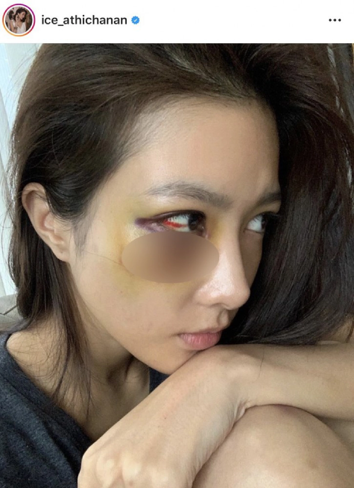สาวไอซ์อัพเดทอาการหลังม้วนแร็ปกระแทกใส่หน้าเขียวช้ำหนัก 