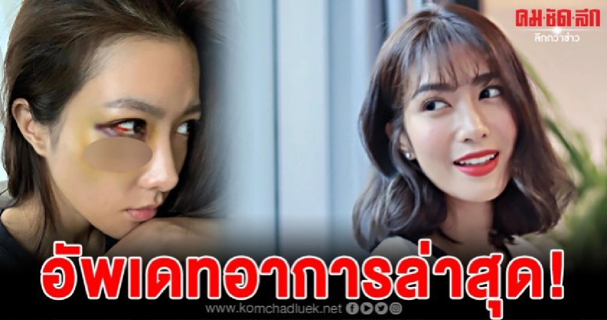 สาวไอซ์อัพเดทอาการหลังม้วนแร็ปกระแทกใส่หน้าเขียวช้ำหนัก สาวไอซ์อัพเดทอาการหลังม้วนแร็ปกระแทกใส่หน้าเขียวช้ำหนัก
