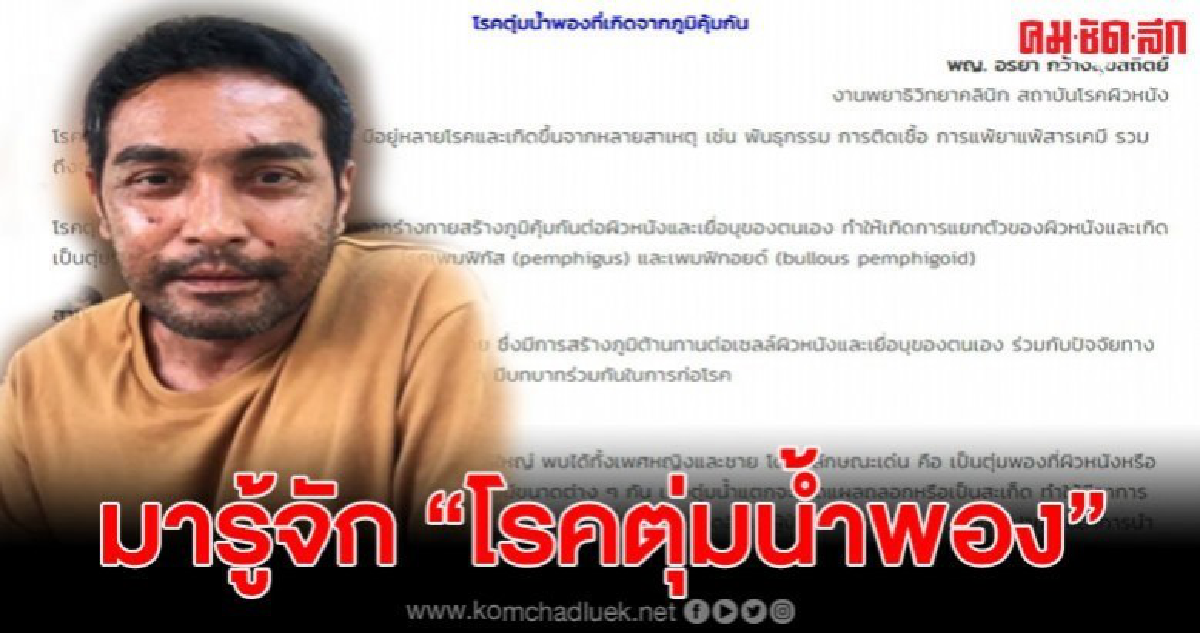 พามารู้จักโรคตุ่มน้ำพองที่  'เมฆ' วินัย ไกรบุตร ป่วย