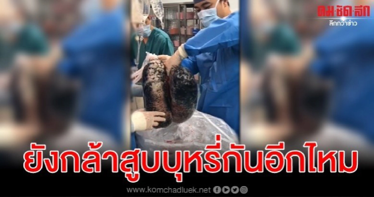 หมอจีนเผยคลิปปอดสีดำสิงห์อมควัน สูบวันละซอง 30 ปี