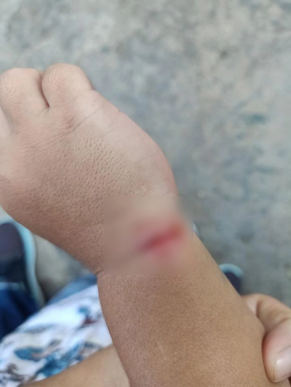 ลูกน้อยเอาหนังยางใส่ข้อมือ รู้ตัวอีกทียางรัดจนแผลเหวอะ