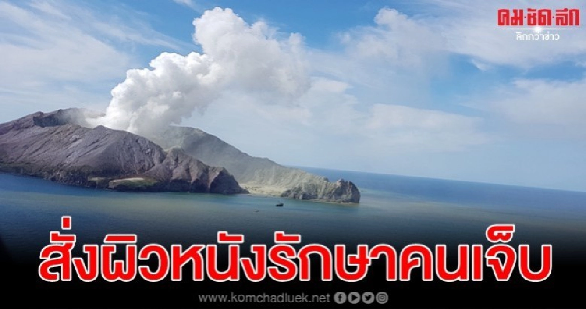 นิวซีแลนด์สั่งผิวหนัง 1,290 ตร.ฟุตช่วยคนเจ็บภูเขาไฟปะทุ 