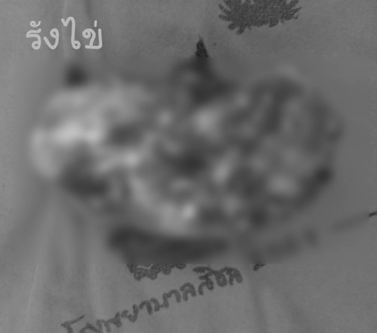เตือนผู้หญิงที่ปวดท้องน้อยบ่อยๆ ระวังจะเสียเงินเป็นแสนรักษา