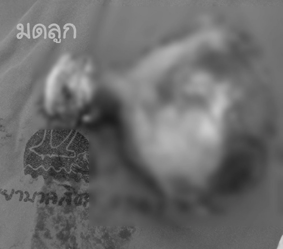 เตือนผู้หญิงที่ปวดท้องน้อยบ่อยๆ ระวังจะเสียเงินเป็นแสนรักษา