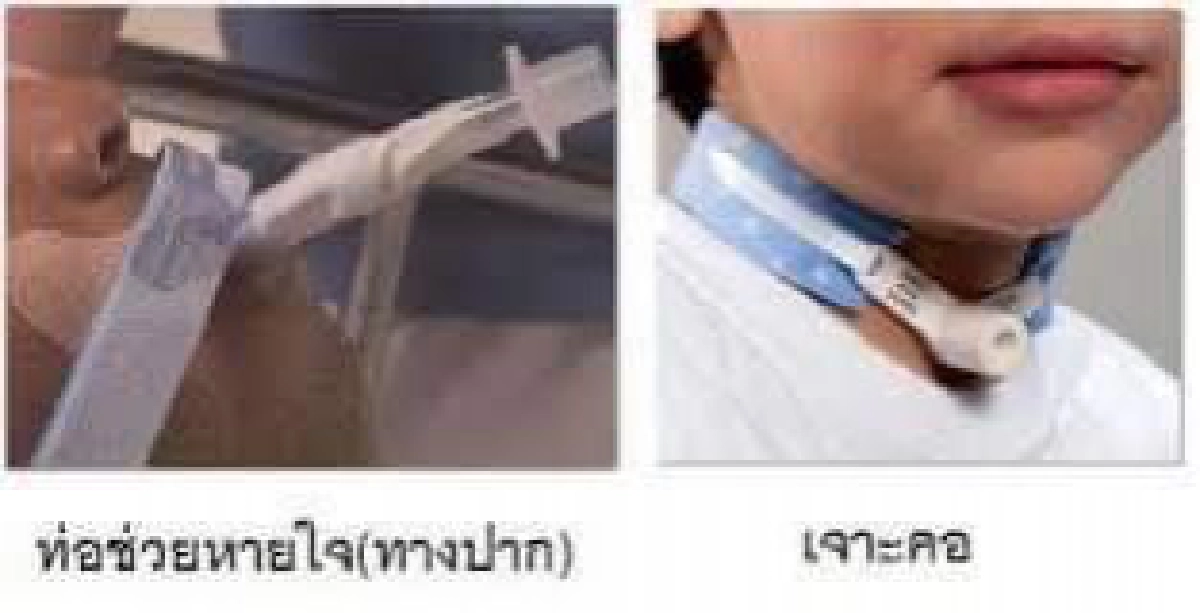 เพจดังแนะ รพ.ฟ้องญาติดราม่าเจาะคอ